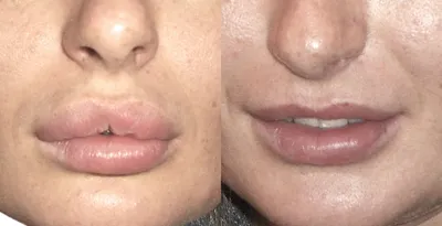 Удаление биополимерного геля из губ: фото до и после — через 1 месяц |  Пластический хирург Орландо Салас