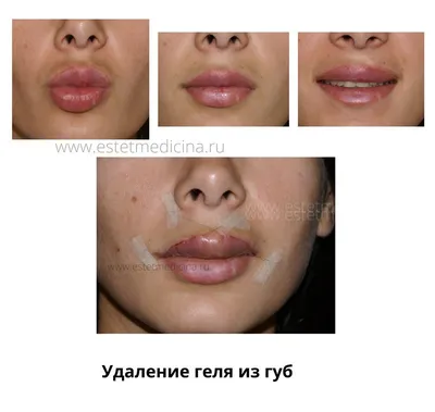 Удаление биополимерного геля из губ в Москве | Damas Medical Center