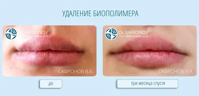 Карина Дикинова on Instagram: \"Фото до: биополимерный гель в губах +  гиалуроновая кислота. Ранее была попытка удаления (не у меня). До операции  вывели лонгидазой ГК. Далее губки после операции удаления биополимерного  геля.
