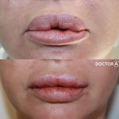 Удаление биополимерного геля из губ. Видео до и на 7 день после операции.  Оцените результат 🙂 | Instagram