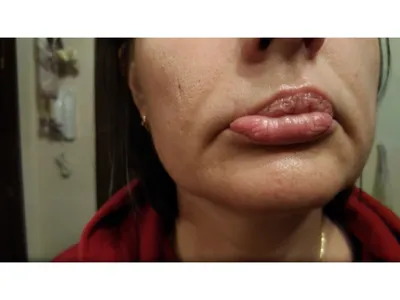 Твердые губы после увеличения (шарики, плотные, комочки внутри,  уплотнения): как убрать, что делать, как долго проходят, избавиться -  Клиника красоты Bellezza Киев
