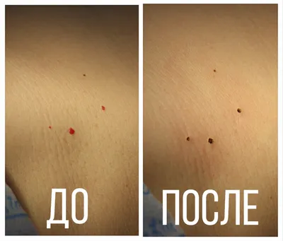 Лазерное удаление бородавок, папиллом, родинок, новообразований - «Лёгким  движением лазера я избавилась за пару минут от назойливой родинки на носу.  Быстро, без крови, практически безболезненно.» | отзывы