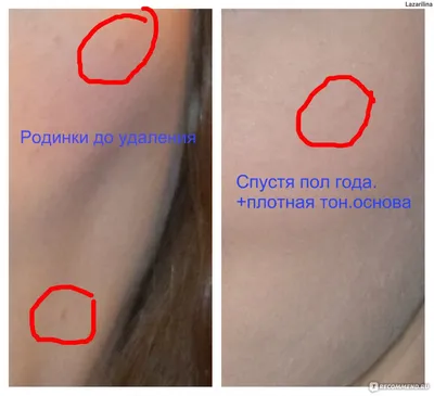 Лазерное удаление родинок » Салон лазерной косметологии \"ЛИЛУ\"