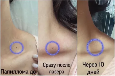 Фото галерея удаления родинок лазером в МЛЦ Алматы
