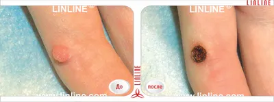 ⭐ Лазерное удаление папиллом в Минске, цена удаления папиллом лазером