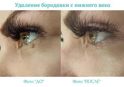Лазерное удаление родинок и невусов недорого - цена в СПб | Центр лазерной  эпиляции