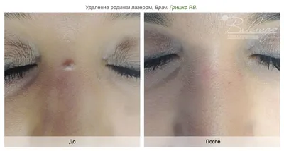 Удаление лазером новообразований в Москве - цена приема от 1500 руб