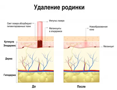Хирургическое удаление родинок - Центр европейской дерматологии