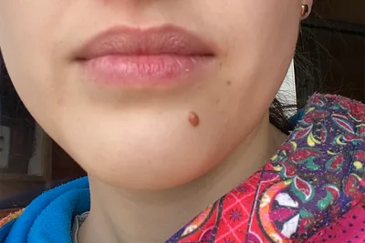Удаление родинок лазером