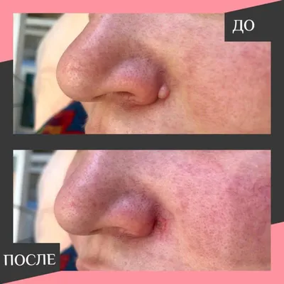 Лазерное удаление бородавок, папиллом, родинок, новообразований - «Удаление  родинок лазером на лице. Фото через 5 дней, 2 месяца, пол года, 3 года.» |  отзывы