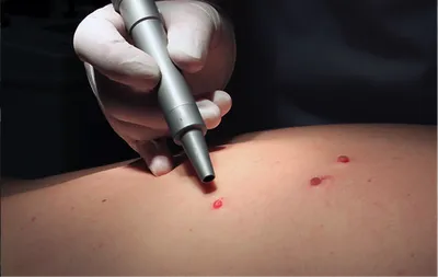 Фото до и после удаления новообразований | Клиника Damas Clinic