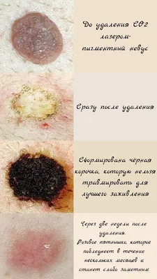 Удаление родинок, папиллом, бородавок лазером Velure S5 в Липецке