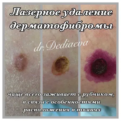 Лазерная дерматохирургия, удаление новообразований лазером