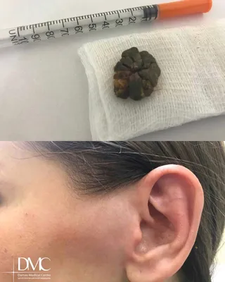 Цены на удаление новообразований в Damas Medical Center