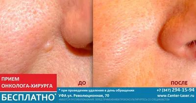 Удаление родинок на лице лазером без шрамов в Харькове | Лазерсвiт