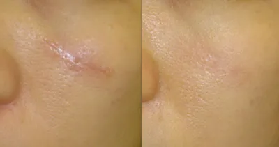 Лечение шрамов и рубцов на лице и теле - способы борьбы