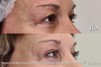 Гипертрофический Keloid шрам на лице женщины до и после удаления лазерной  обработки раны и восстановления после аварии или ущерба Стоковое Фото -  изображение насчитывающей сторона, женщина: 198525256
