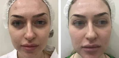 Лазерное удаление шрамов на лице в Киеве, шлифовка Coolaser Clinic