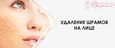 Лазерное удаление шрамов и рубцов в Киеве - клиника Diamond Laser