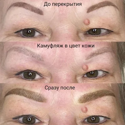Удаление татуажа лазером в Екатеринбурге: цены, фото, видео, отзывы
