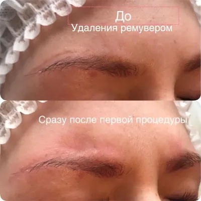 Удаление татуировок и татуажа в Новосибирске. Лазерное удаление татуажа и  татуировок по цене от 1500 руб.