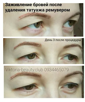 Удаление татуажа / тату ремувером | Viktoria Beauty Club