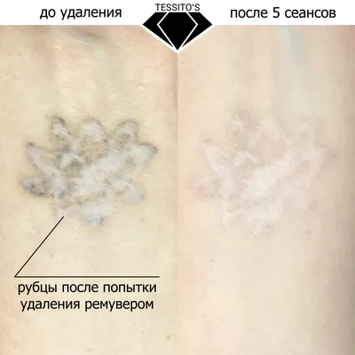 Удаление татуажа бровей Revivink в Москве, цены – лазерное удаление  перманентного макияжа в салоне красоты