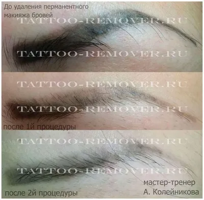 Удаление тату, тауажа ремувером, Ремувер в Новосибирске, Салон татуажа