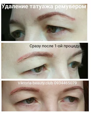 Удаление татуажа / тату ремувером | Viktoria Beauty Club
