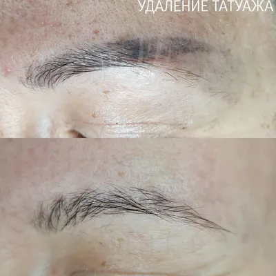 Студия перманентного макияжа Виктории Громовой в Харькове. Удаление Татуажа  Ремувером