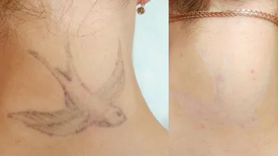 Удаление татуировок лазером фото фотографии