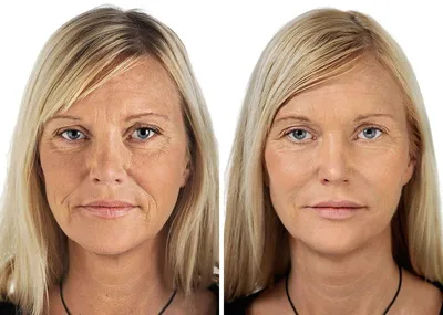 Биоревитализация лица - фото до и после, цена за 1 процедуру Саратов