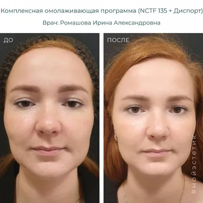 Биоревитализация кожи в Москве: цены, отзывы. Найти мастера по  биоревитализации лица на Профи