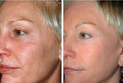 Фото до и после косметологических процедур | Клиника доктора Гришкяна