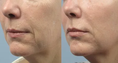 Портфолио косметологии: фото \"до и после\", реальные примеры работ врачей  клиники Груздева