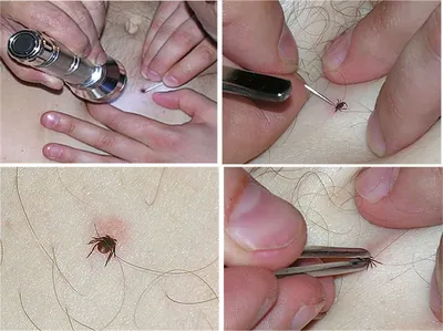 Фото: как выглядят укусы клещей у человека на теле