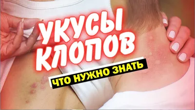 Как выглядит укус постельного клопа на человеке? Фото - СЭС