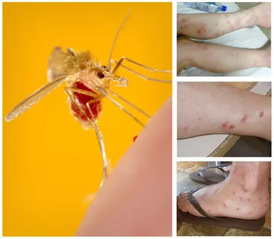 Аллергия на укусы кровососущих насекомых: как проявляется и чем опасна -  Все про аллергию