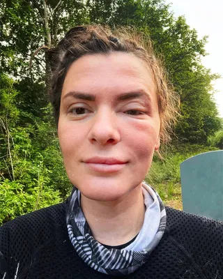 Путешественница Анна Смолина из Челнов показала, как распух ее глаз после  укуса мошки | Челнинские известия | Дзен