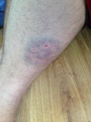 Нога после укуса бродячей собаки распухла у пострадавшей в Кривом Роге —  Новости Кривого Рога