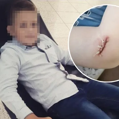Под Новосибирском собака разорвала руку 10-летнему мальчику: хозяева пса  обвинили во всем ребенка - KP.RU