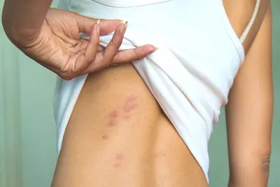 Укусы насекомых - Консультация Дерматолога Онлайн iDerma