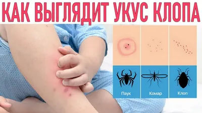 Аллергия на укусы насекомых (отек, зуд) – симптомы, проявление и лечение