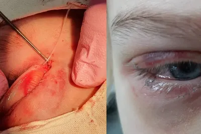 Офтальмологи помогли девочке, которую укусила собака | Министерство  здравоохранения Чувашской Республики