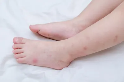 Как выглядят укусы постельных клопов на теле человека? | ДезСтанция