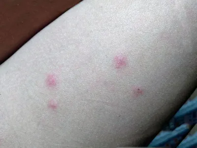Укусы насекомых - Консультация Дерматолога Онлайн iDerma