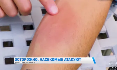 Укусы насекомых: меры безопасности и помощь при укусах
