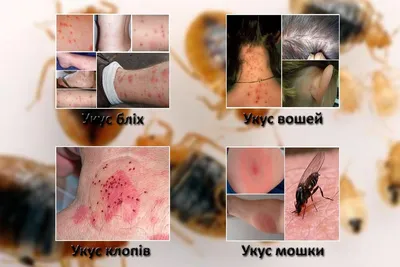 Последствия от Укусов Муравьев - Марафет