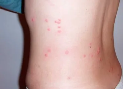Укусы насекомых - Консультация Дерматолога Онлайн iDerma