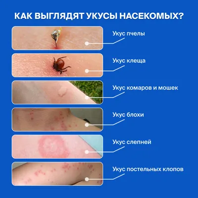 ЧТО НЕОБХОДИМО ЗНАТЬ ПРО УКУСЫ НАСЕКОМЫХ